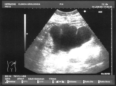 Ecografia renale in paziente con rene muto da lesione iatrogena dell’uretere