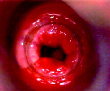 Anoscopia a T0, edema e segni di recente sanguinamento