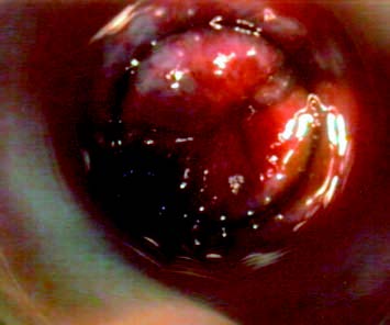 Anoscopia a T0, prolasso emorroidario