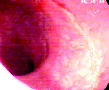 Endoscopia rettale. Anastomosi post intervento di prolasectomia